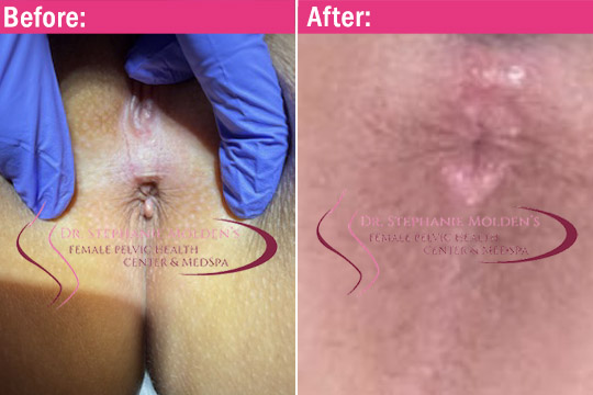 Female Pelvic Health Center (Newtown PA) - Skin Tag Removal Before and After