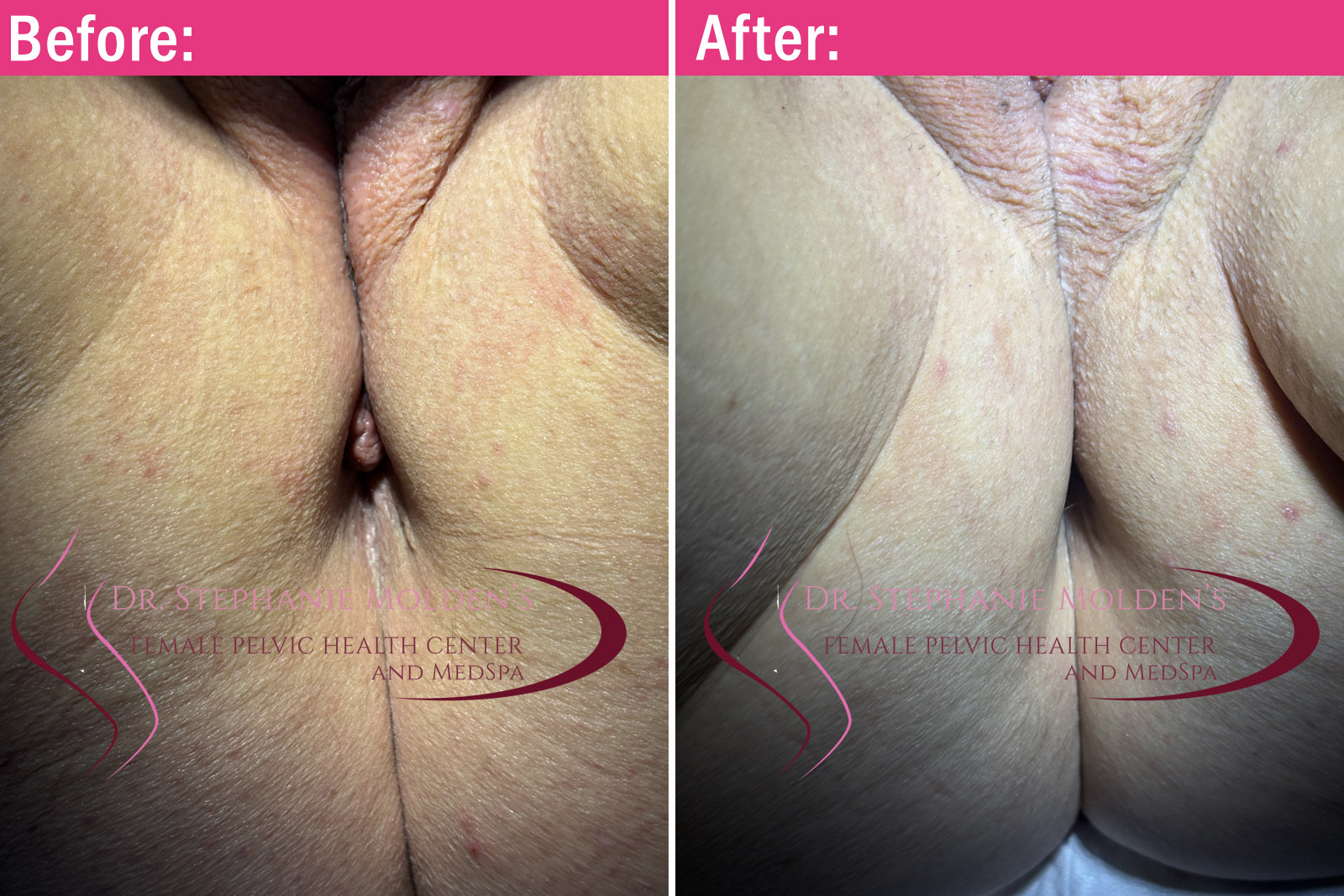 Female Pelvic Health Center (Newtown PA) - Anal Skin Tag Removal Before and After